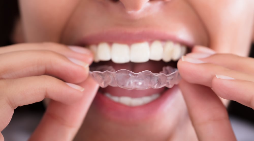 A person with bright white teeth puts in a set of Invisalign aligners.